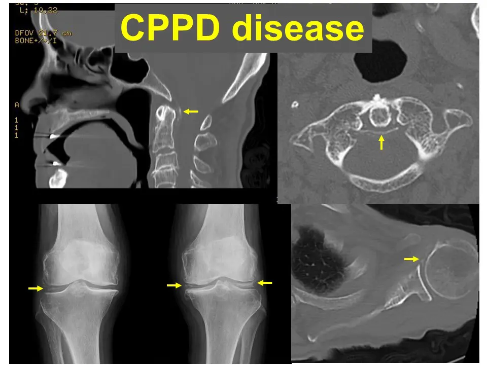 偽痛風のはなし | つつみ内科・脳神経内科・リウマチ科